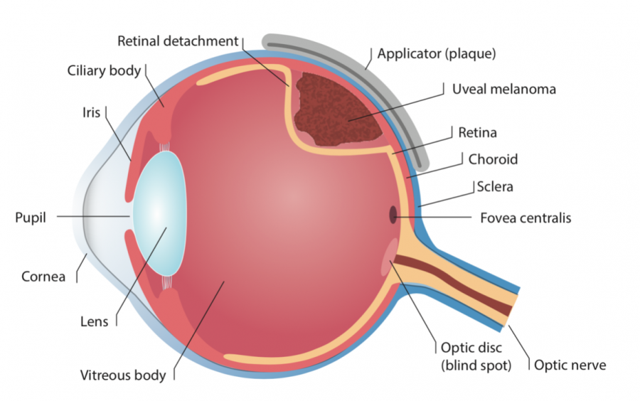 Choroidal Melanoma - CTOOS